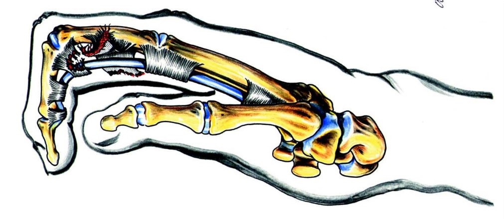 Anatomic draw of the side of a hand, seeing the bones in the thumb and index finger.
